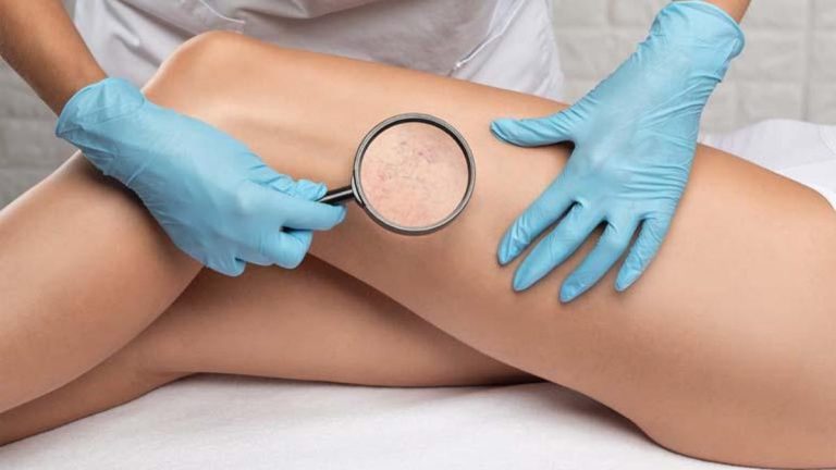 Varisli damarlar sadece estetik açıdan değil, ciddi bir sağlık sorunudur.