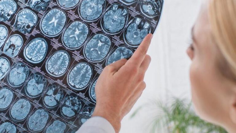 Birleşik Krallık’ta serebral kanaması olan bir kişi, kafatasının parçasını midede taşıdı