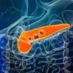 Pankreas kanserinde umut verici ilerleme: ‘Yaşam süresi yüzde 54 arttı’